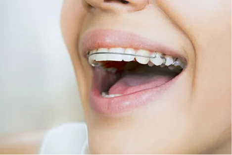 Are Adult Orthodontics Really Worth It?