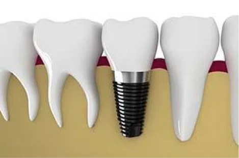 How Dental Implants are Placed in the Jawbone