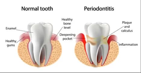 Periodontics Can Save Your Smile by Restoring Your Gums