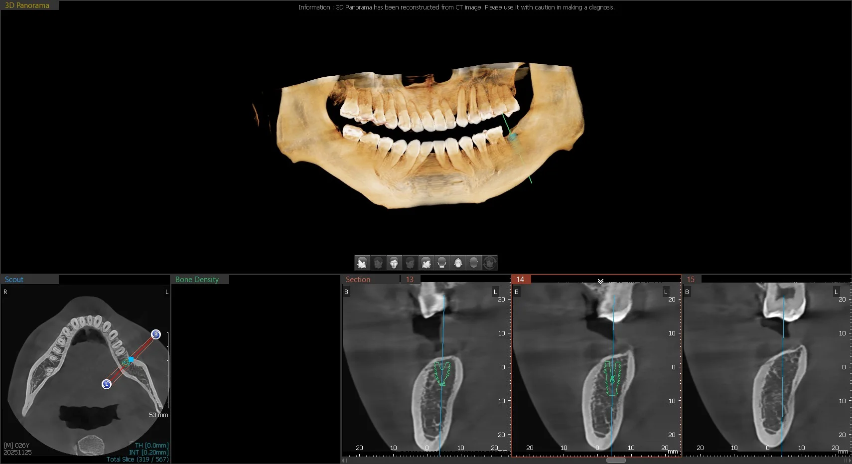 3D reconstructed jaw