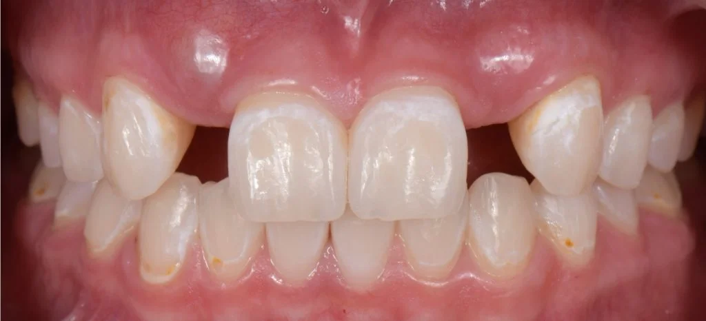 Congenitally missing tooth