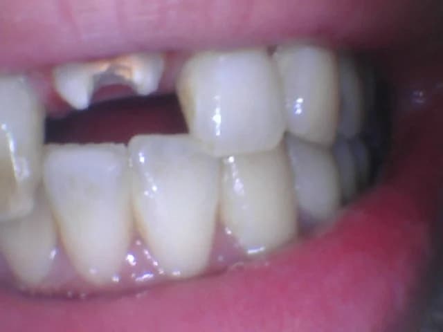 Fractured tooth or crown