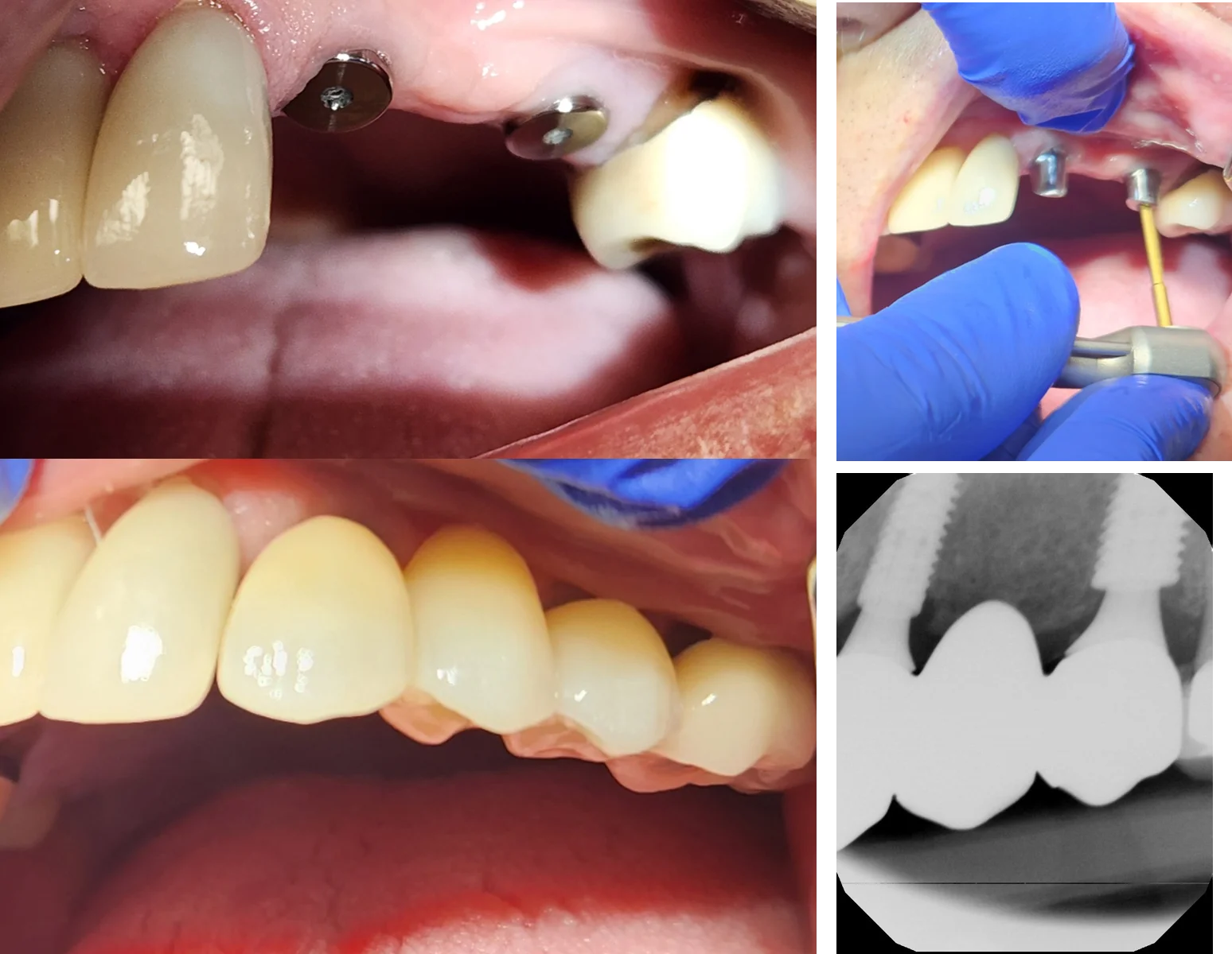 Multiple implants placement