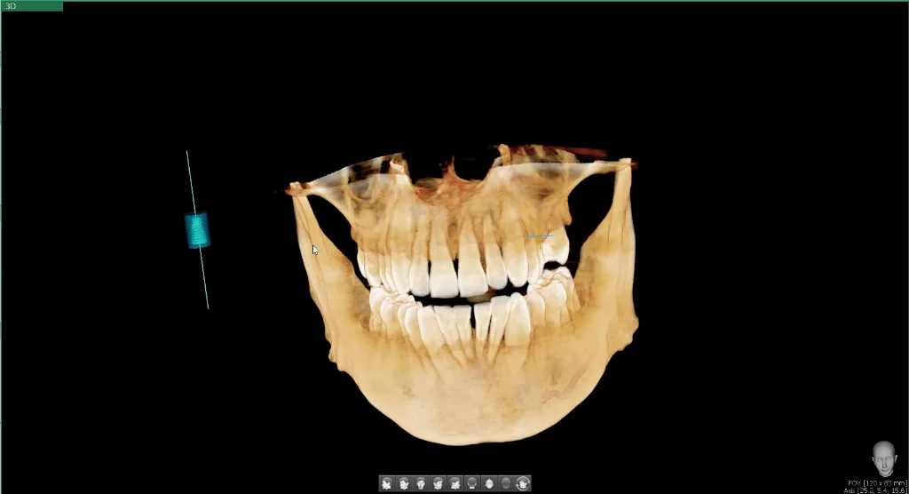 3D planning and full-arch scan