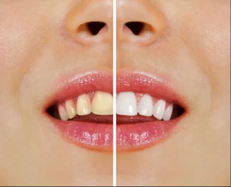 Teeth Whitening and Sensitive Teeth: Tips From the American Dental Association