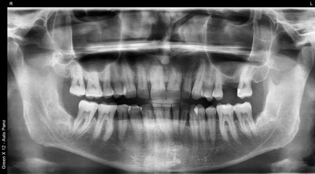 Panoramic x-ray showing full mouth